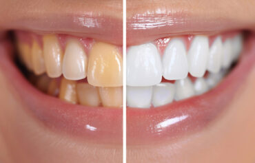 Blanqueamiento Dental